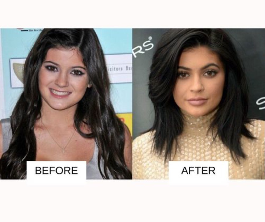 Kylie Jenner előtte utána