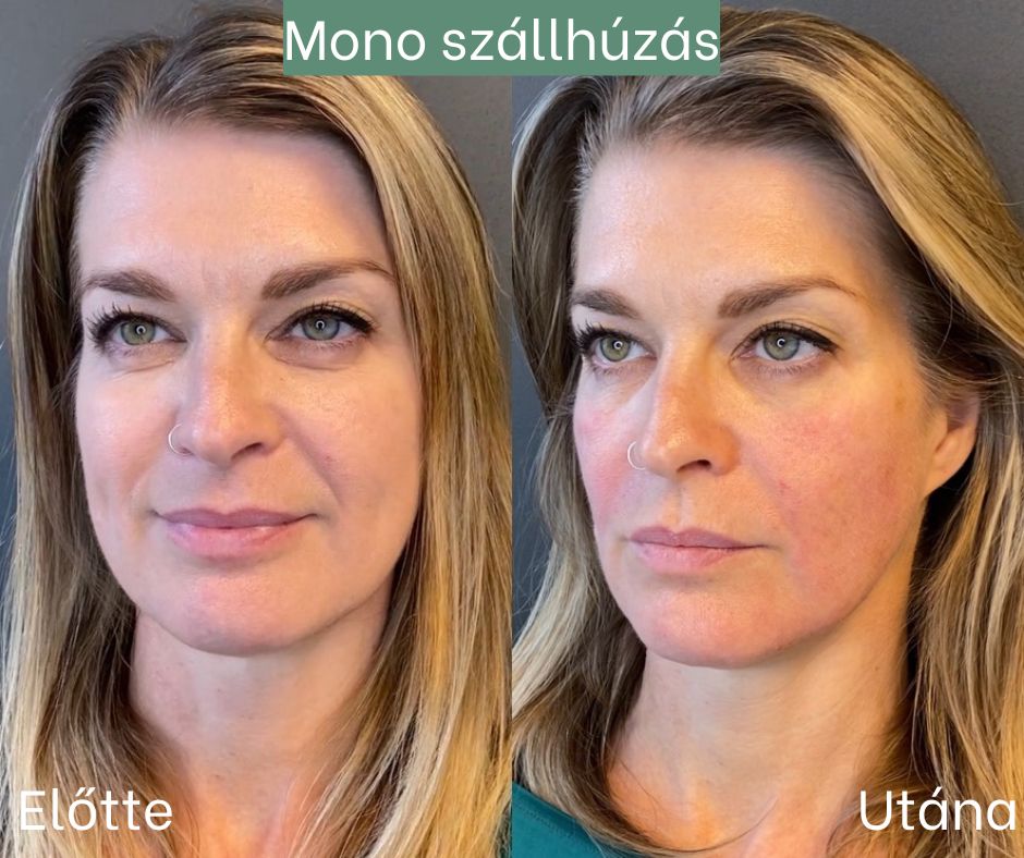 mono szállhúzás mono szállhúzás