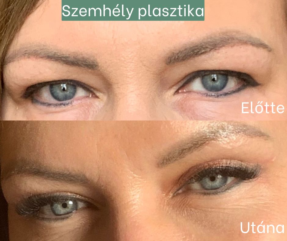 szemhéj plasztika szemhéj plasztika