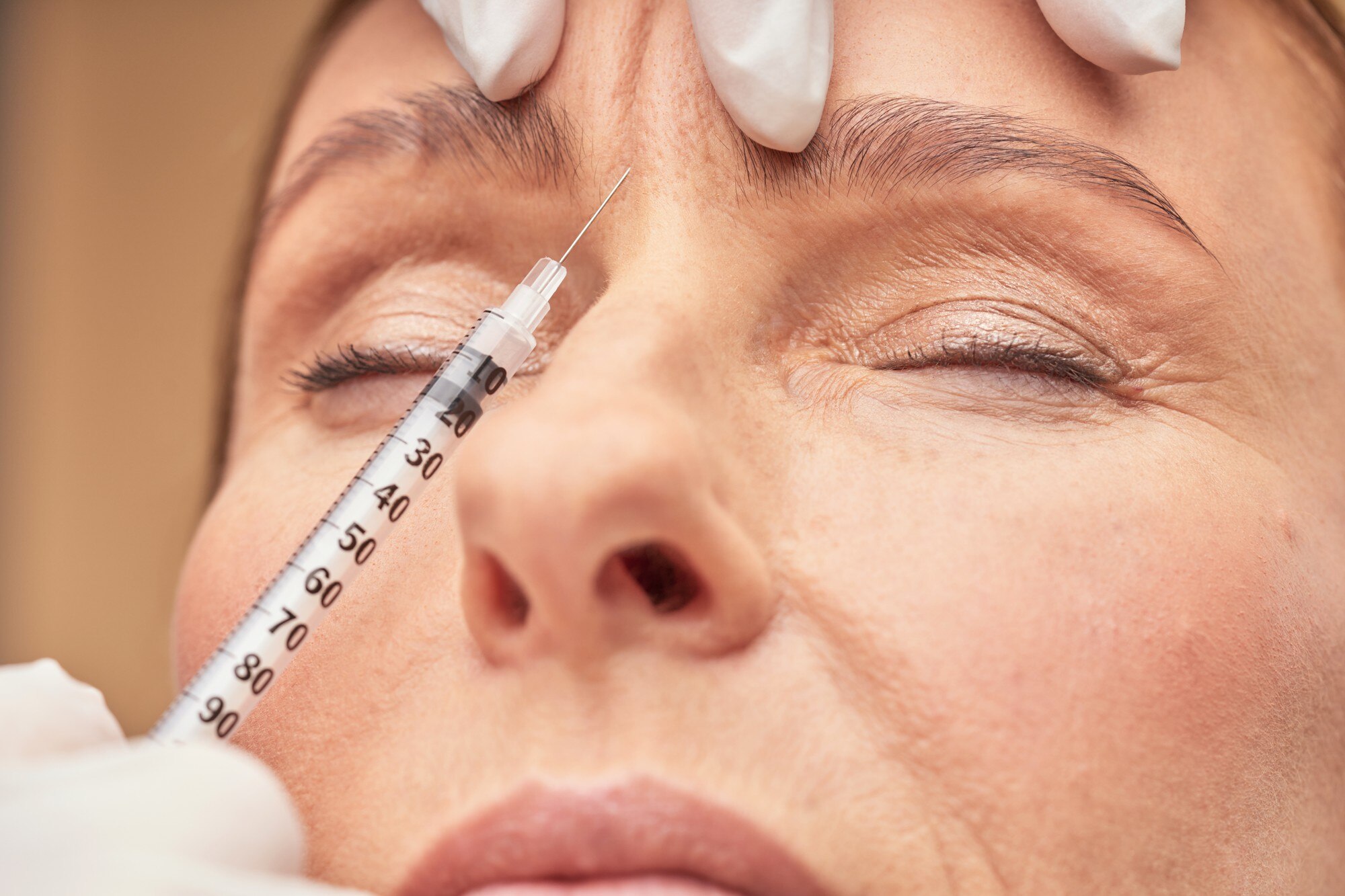 Glabella botox a homlokredők eltüntetésére. Glabella botox a homlokredők eltüntetésére.